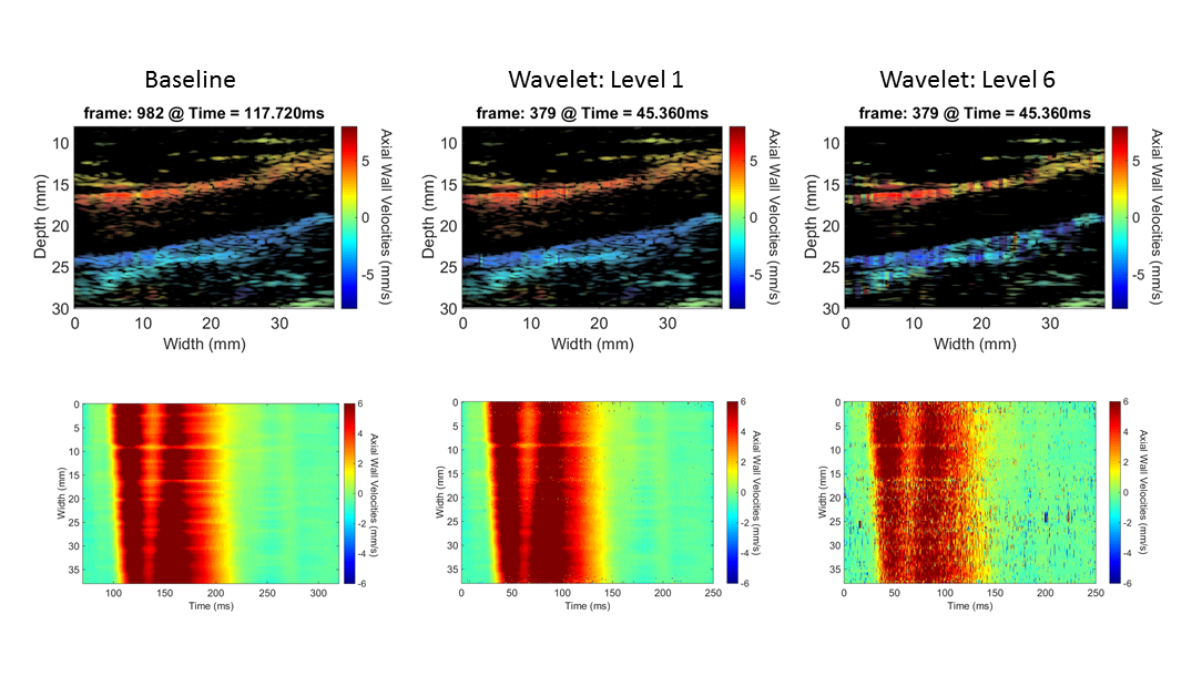 PWI images at specific time instants (top) and the spatio-temporal imaging of pulse-wave propagation (bottom) for different levels of compression. PWI images at specific time instants (top), and the spatio-temporal imaging of pulse-wave propagation (bottom).